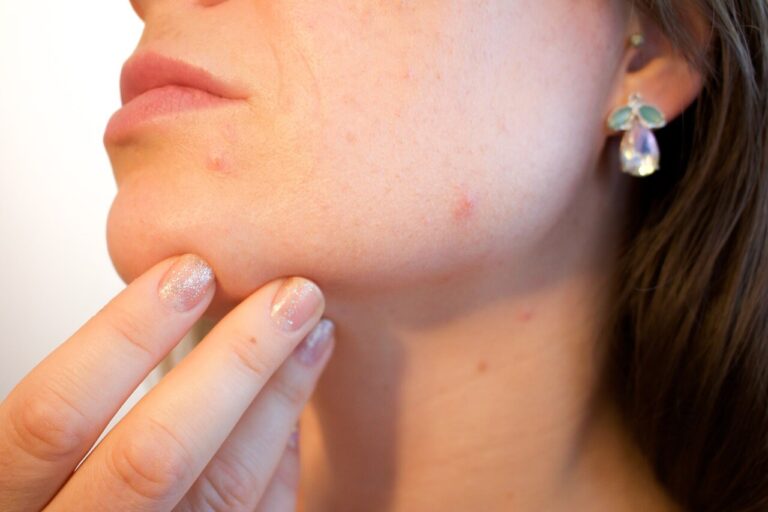 Beauty Tips! What is a Acne, Causes, Precautions, Treatment